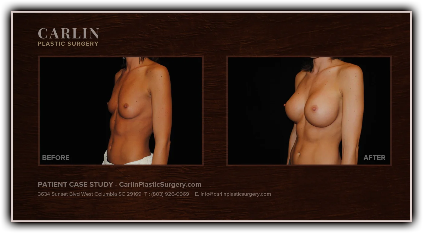 Breast Augmentation before and after — patient 12, side view left