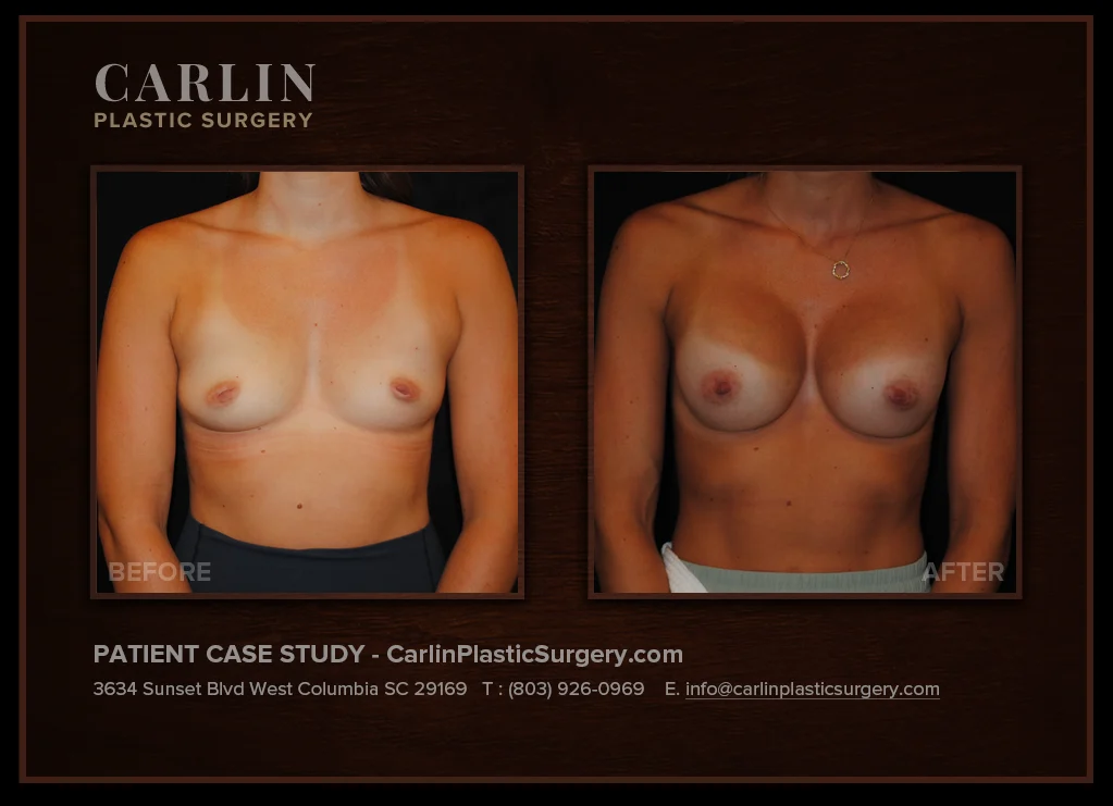Breast Augmentation before and after, patient 21, front view