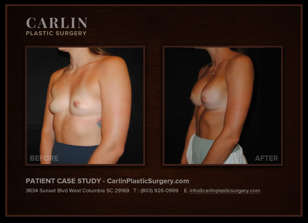Breast Augmentation before and after, patient 21, left oblique view