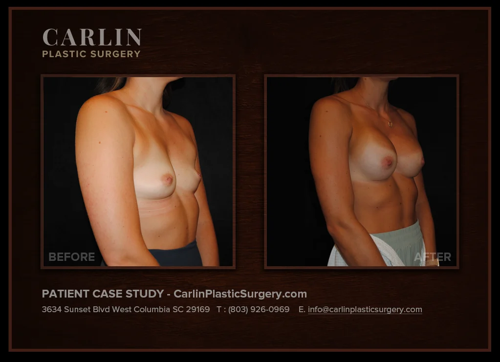 Breast Augmentation before and after, patient 21, right oblique view