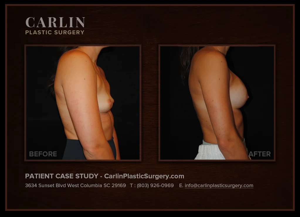 Breast Augmentation before and after, patient 21, right side view