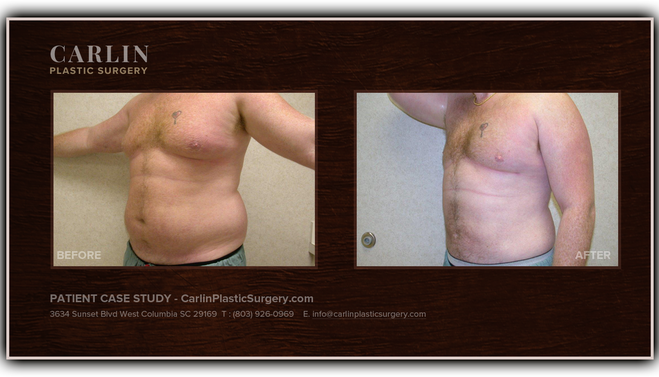 Columbia SC Male Breast Reduction Dr. Brett Carlin M.D